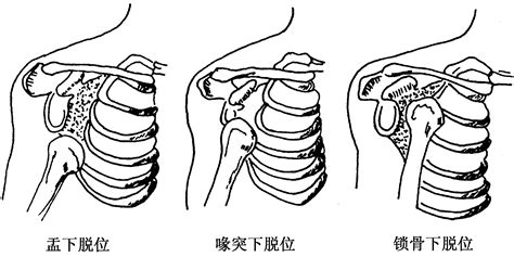 二、常见关节脱位复位术 全科医生 医学