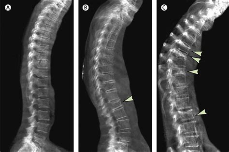 Severe Osteoporosis X Ray