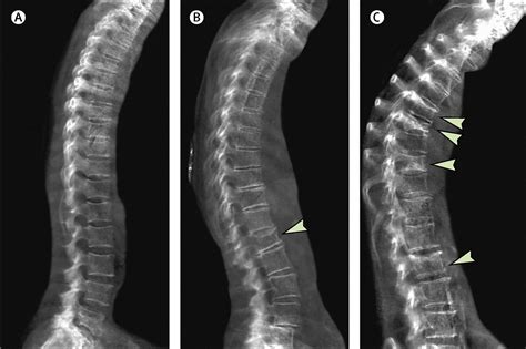 Severe Osteoporosis X Ray