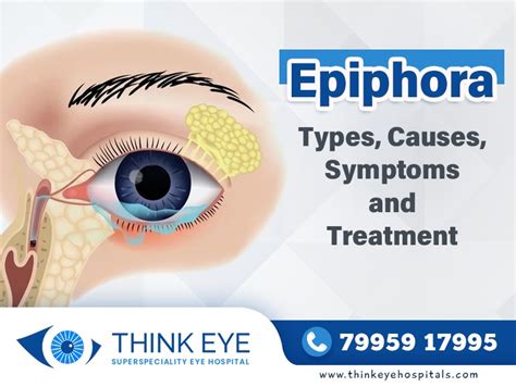 Epiphora Types, Causes, Symptoms and Treatment - Think Eye Hospitals