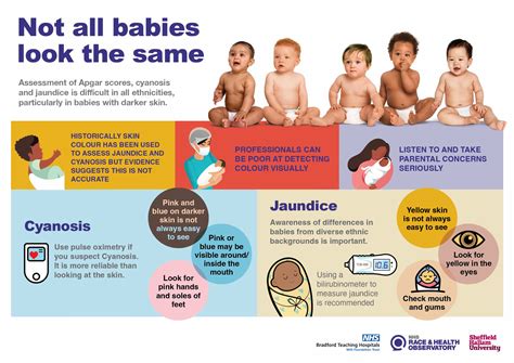 How Long Does Mild Jaundice Last In Newborns