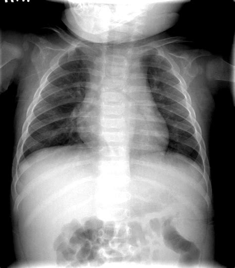 A Frontal Chest Radiograph Obtained On The First Admission Shows Download Scientific Diagram