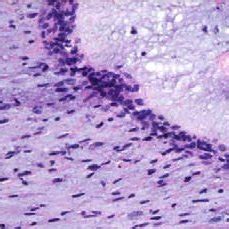 Photomicrograph Of Phyllodes Tumor Showing The Benign Epithelium