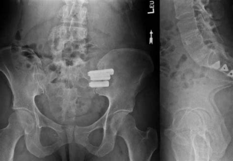 Sacroiliac Joint Fusion Longhorn Brain And Spine