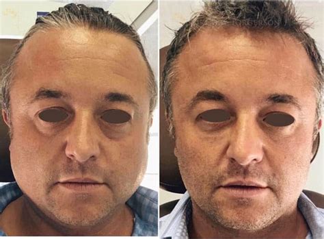 Masseter Botox Before And After Gallery Dr Cory Torgerson