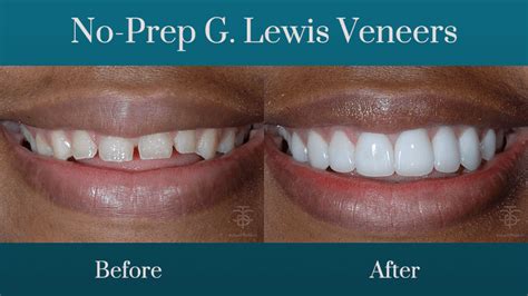 5 WAYS VENEERS CAN IMPROVE YOUR SMILE AND TURN BACK TIME