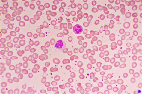 Essential Thrombocytosis Blood Smear With Neutrophil Cell Stock Photo