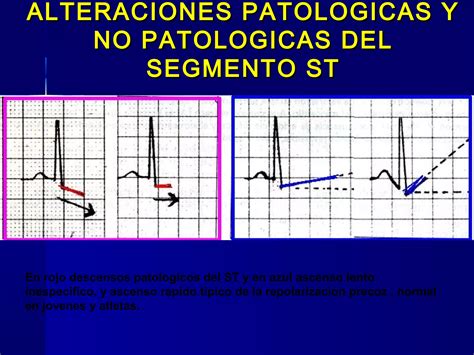 Isquemia Lesi N Y Necrosis Ppt