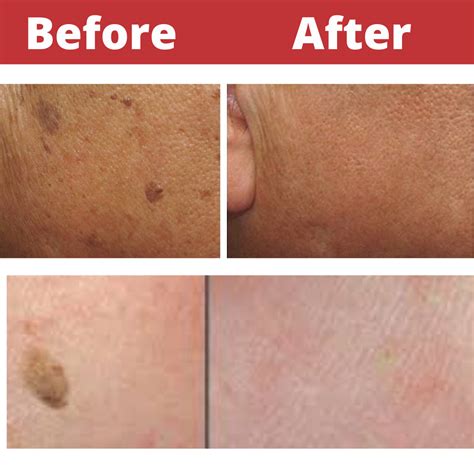 The Seborrheic Keratosis Removal Solution The Specialised Cosmetic