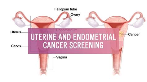 Vaginal And Vulvar Cancer Screening