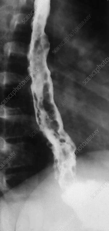 Esophageal Varices X Ray