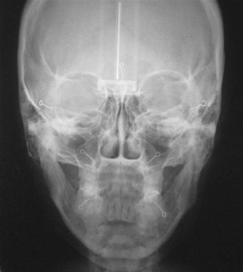 Final Postoperative Posteroanterior Radiograph Download Scientific Diagram