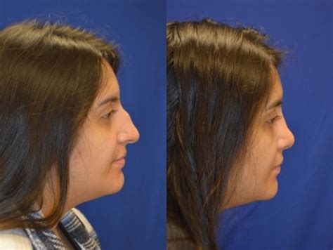 Nose Surgery Before And After Photos Patient 310 San Francisco Ca Kaiser Permanente Cosmetic