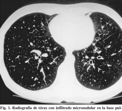 Figure From Absceso Hep Tico Tuberculoso En Paciente Inmigrante Con