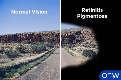 Retinitis Pigmentosa Causes Symptoms Diagnosis And Treatments