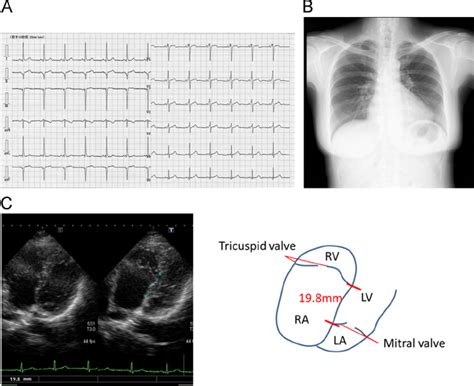 A A Lead Surface Electrocardiogram During Sinus Rhythm