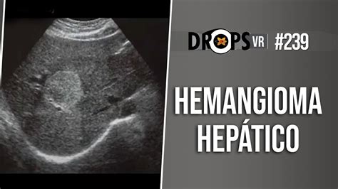 Hemangioma Hep Tico Principais Caracter Sticas Youtube