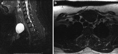 Of The Pediatric Thymus And Thymic Disorders Radiology Key