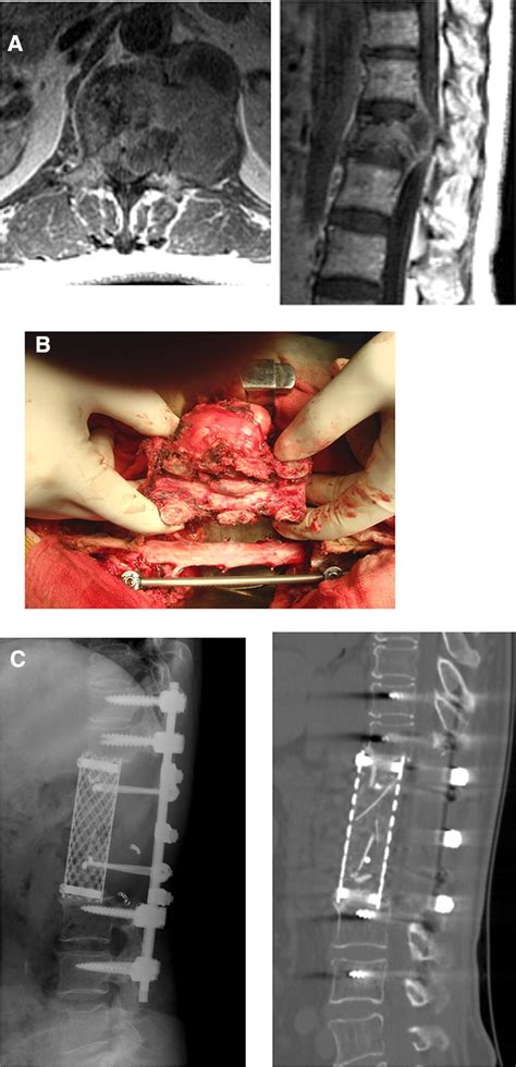 Metastatic Leiomyosarcoma At L In A Year Old Woman A Axial Left