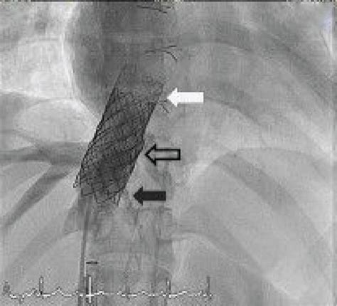 A second bare stent was then applied over the overlapping section of ...