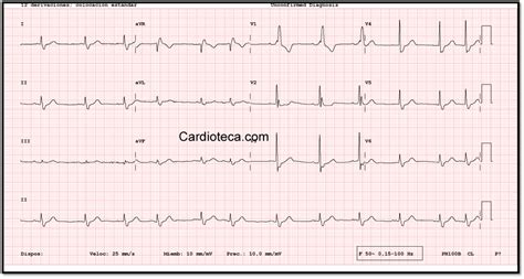 Curso ECG BRD