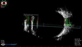 Ophthalmic Ultrasound Sonomed Escalon