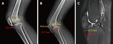 Preoperative Lateral Radiograph Of The Left Knee And Measurement Of The