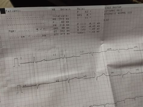 Ask A Cardiologist Online For Want To Know About Ecg Report