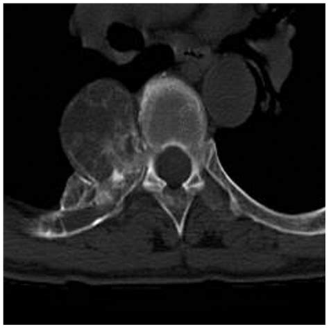 Osteoblastoma Of The Rib With Ct And Mr Imaging A Case Report And