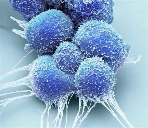 Prostate Cancer Cells Coloured Scanning Electron Micrograph