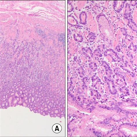 Gross Image Of Resected Specimen A Gastric Adenocarinoma White