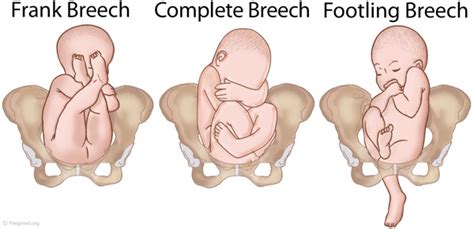 section for breech presentation