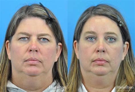 Brow Lift Before And After Gallery