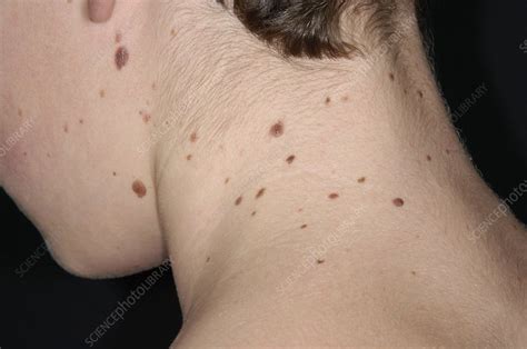 Moles On Neck Meaning