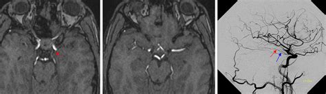 Anterior Choroidal Artery | neuroangio.org