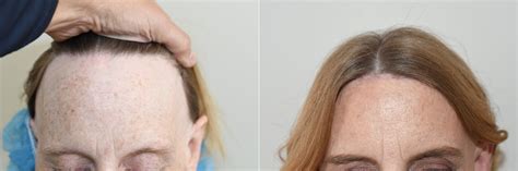 Forehead Reduction Surgery Photos Miami FL Patient127051