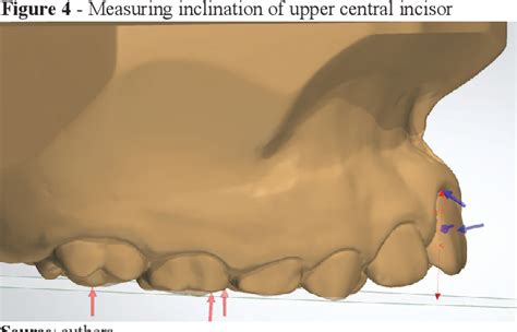 Figure From Anterior Open Bite Treatment With Lingual Spurs And