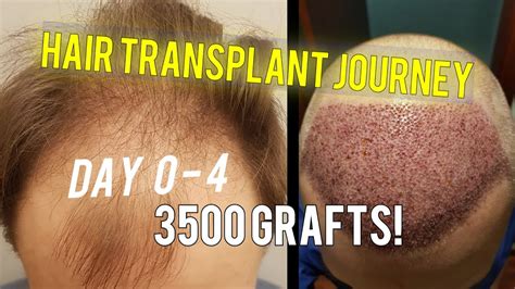 Fue Hair Transplant Procedure Best 3500 Grafts My Hair Transplant Journey In 2020 Youtube