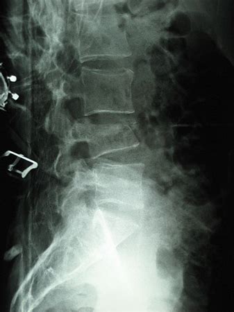 Osteoporotic Vertebral Compression Fracture - Spine - Orthobullets