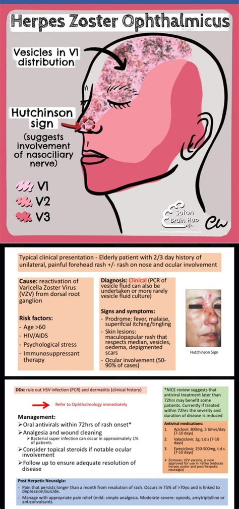 ophthalmic nerve shingles