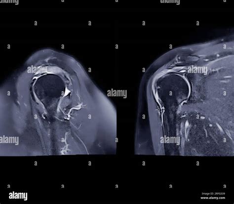 Im Genes Por Resonancia Magn Tica O Irm De La Articulaci N Del Hombro
