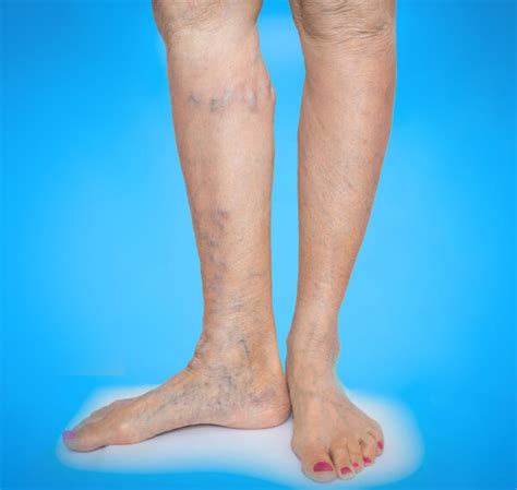 Venefit Procedure For Varicose Veins In Bay Area Ca