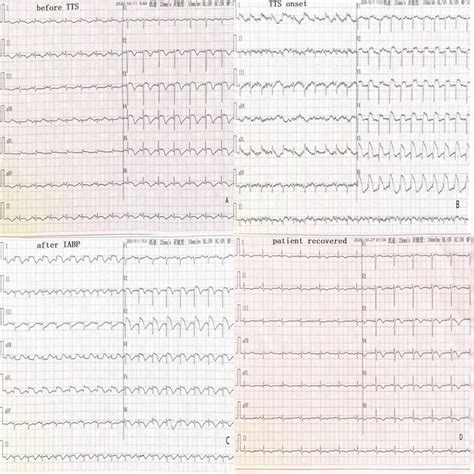 Left Ventriculography Images Systole Left Diastole Right The Download Scientific Diagram