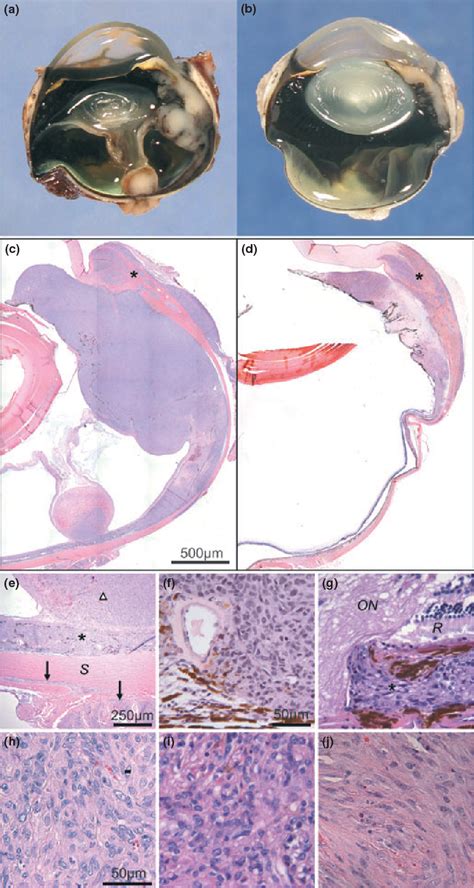 Figure 2 From Bilateral Uveal Metastasis Of A Subcutaneous Fibrosarcoma In A Cat Semantic Scholar