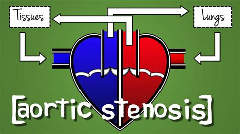 Aortic Stenosis Explained With Animation Youtube