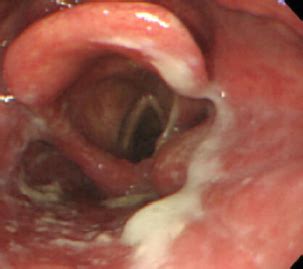 Endoscopia En Esofagitis Infecciosa Gastro M Rida