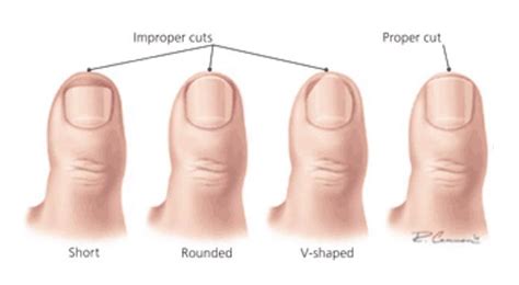 Ingrown/Crushed Fingernail and Toenail Management - Motion Is Medicine