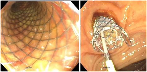 Hemobilia From A Right Hepatic Artery Pseudoaneurysm Due To Chronic