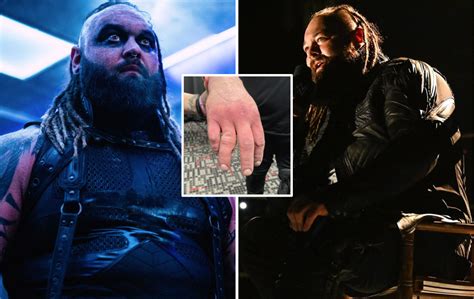 Wwe Bray Wyatt Shows Off Gruesome Injury In New Tweet