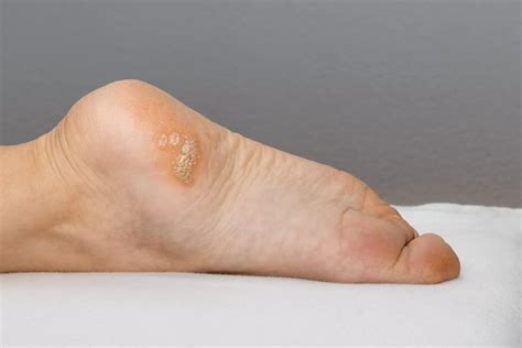 Plantar Warts In Herndon And Springfield Va Nova Foot And Ankle